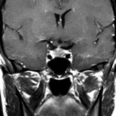 Coronal T1 C+ MR shows typical physiologic pituitary hyperplasia in a 28-year-old lactating woman. The gland has a mildly convex superior margin and measures nearly 14 mm in height.