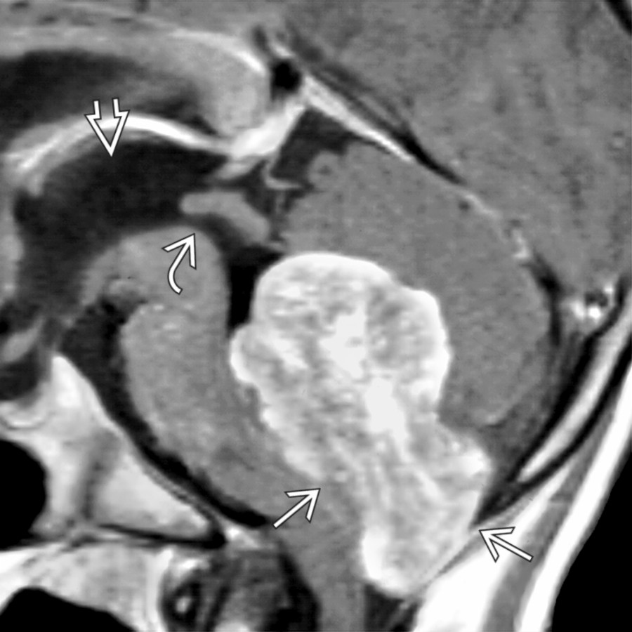 Sagittal T1WI C+ MR shows enhancing tissue extruding through the foramen of Magendie, filling the cisterna magna . Resultant obstruction has caused enlargement of the cerebral aqueduct  and dilated 3rd ventricle .