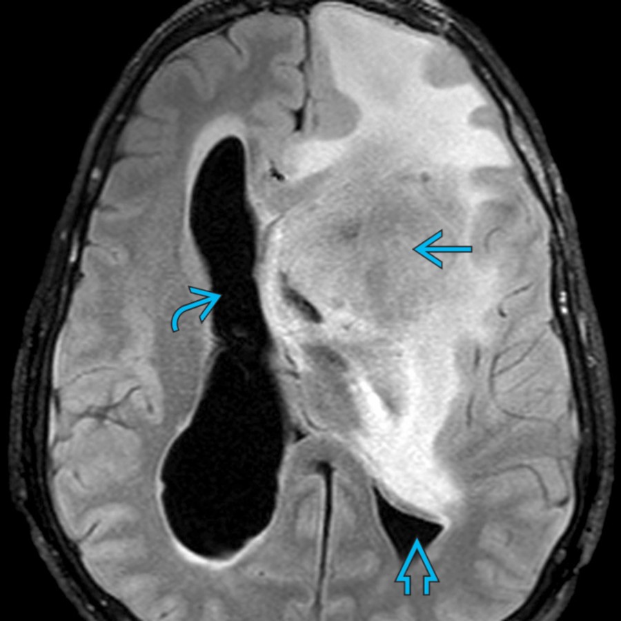 Axial FLAIR MR demonstrates a large,  heterogeneous mass in the left frontal lobe  with surrounding edema and mass effect with compression of the left lateral ventricle  and moderate dilation of the right lateral ventricle .