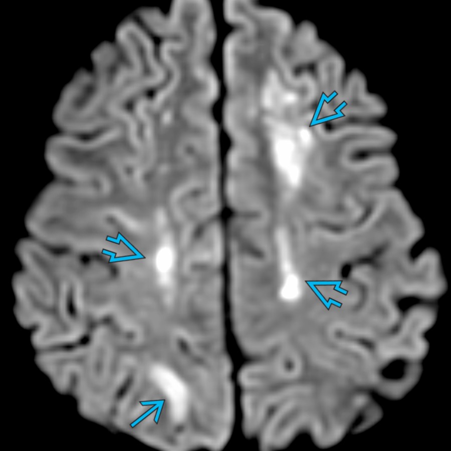 Axial DWI MR in a 12-year-old with reversible cerebral vasoconstriction syndrome (RCVS) who recently started mycophenolate and  presented with acute onset of left-sided weakness shows multifocal cortical  and subcortical  infarcts.