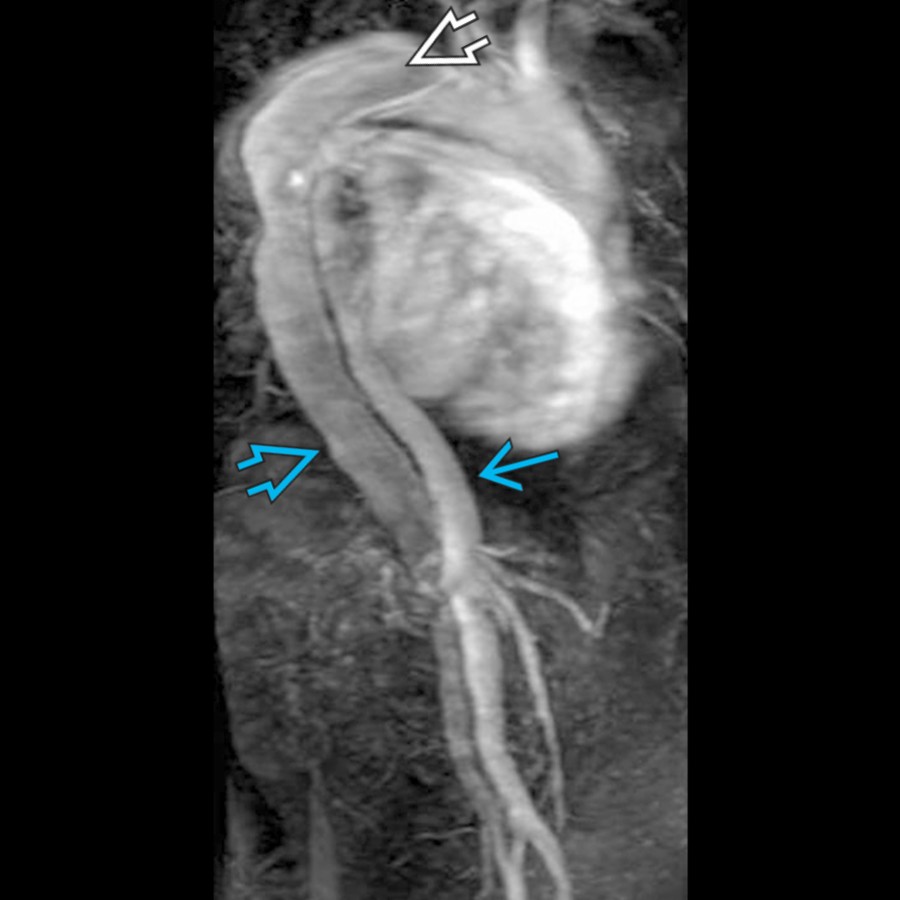Sagittal MRA shows an aortic dissection, which is seen starting from the arch distal to the origin of the left subclavian artery , and extends into the abdominal aorta, extending into the iliac arteries. The true lumen  enhances more than the false lumen .