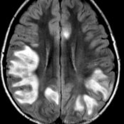 Axial FLAIR MR shows peripheral, confluent areas of hyperintensity predominantly involving the subcortical white matter (WM) in this child with ADEM. The bilateral but asymmetric pattern is typical of ADEM.