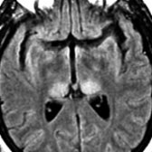 Axial FLAIR MR shows bilateral, symmetric hyperintensities in the posterior thalami representing the "pulvinar" sign, which is characteristic of vCJD. Another "pulvinar" sign is the T1 shortening seen in Fabry disease.