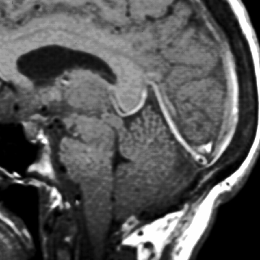 Sagittal T1WI MR shows "sagging" midbrain, tonsillar herniation, and the optic chiasm "draped" over the dorsum sellae. T1WI C+ MR (not shown) demonstrated diffuse dural enhancement in this classic case of spontaneous IH.