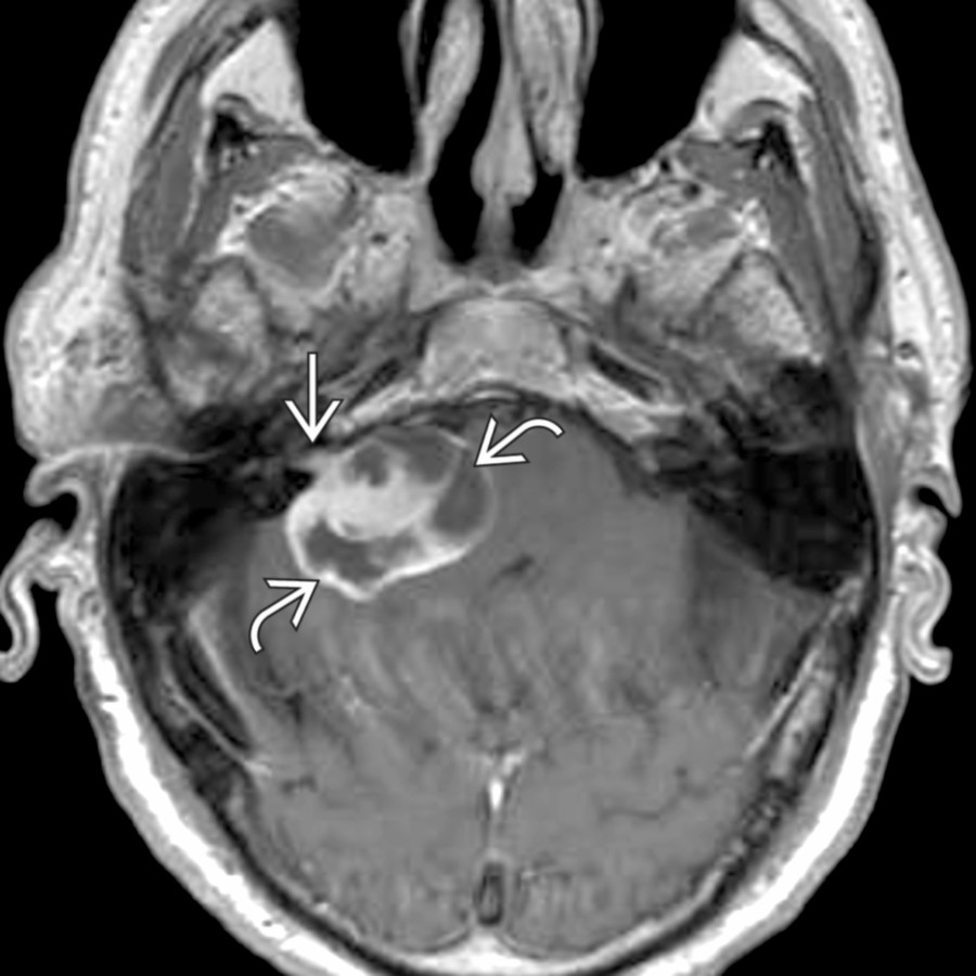 Axial T1 C+ MR shows a partly cystic and solid, heterogeneously enhancing, vestibular schwannoma  involving the right cerebellopontine angle cistern and extending into the internal auditory canal .
