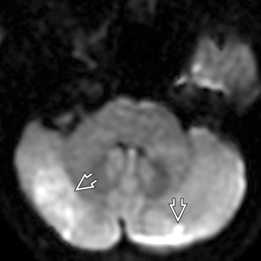 Axial DWI MR in a 45-year-old woman with an abnormal cardiac valve resulting in embolic disease in multiple vascular distributions 5 days after a posterior circulation infarct shows high signal  due to restricted diffusion in bilateral cerebellar hemispheres. DWI scans can be hyperintense up to 7-10 days following acute stroke onset.