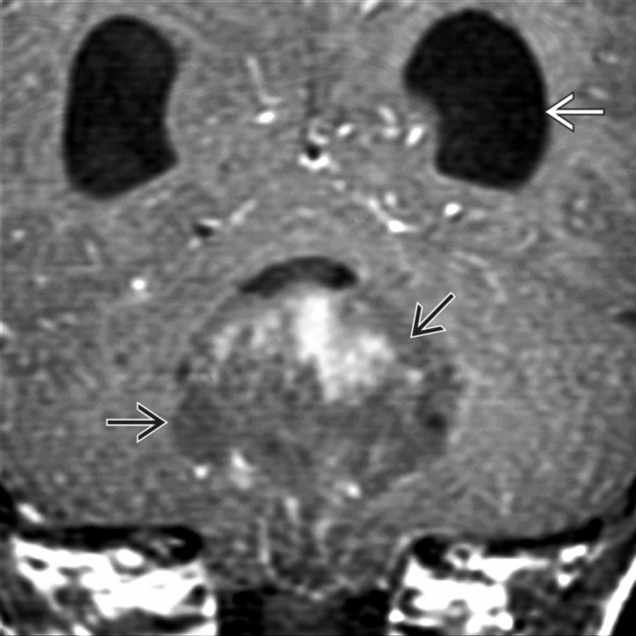 Coronal T1 C+ MR shows IVOH with a large enhancing intraventricular mass  causing marked enlargement of the lateral ventricles .