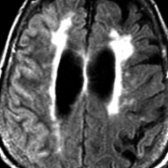 Axial FLAIR MR in the same patient shows changes of late acute/early subacute infarction in the right hemisphere , old focal cortical infarcts in the left hemisphere , and diffuse confluent white matter disease  (arteriolosclerosis).