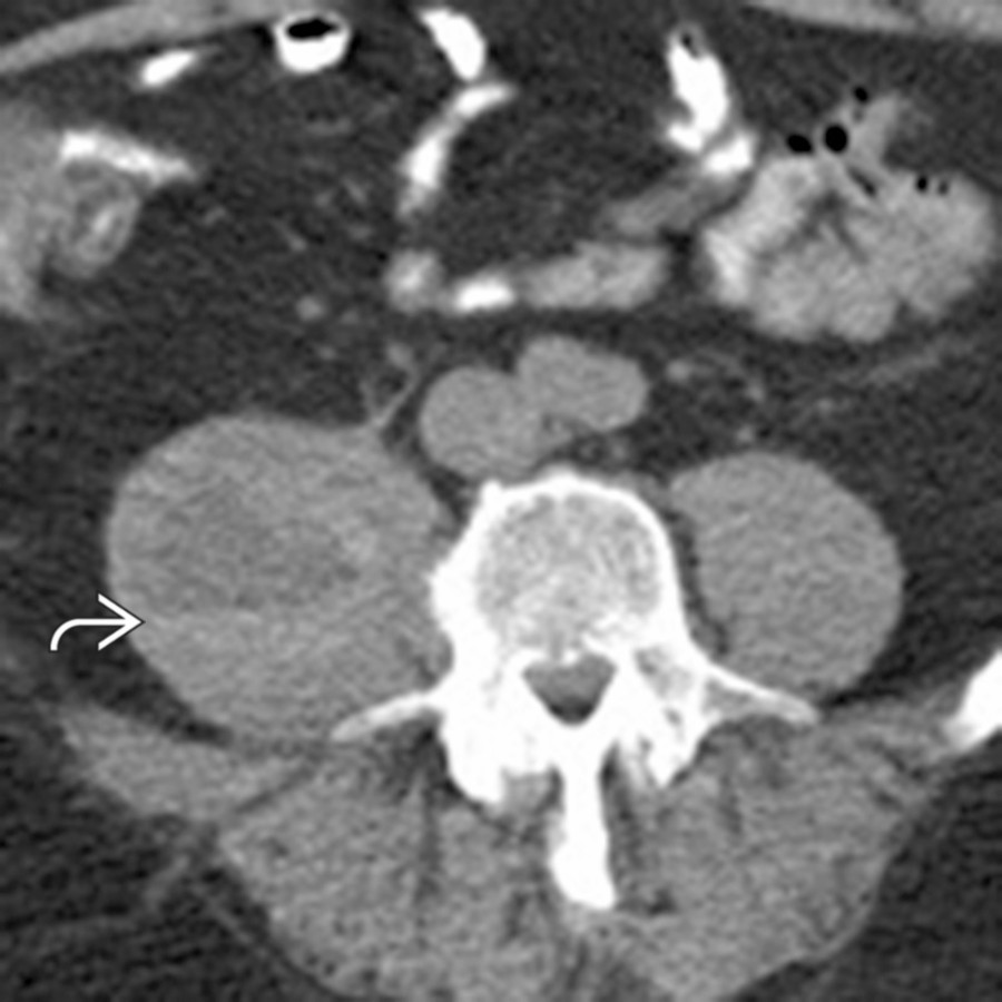Axial NECT shows enlargement of the right psoas muscle due to coagulopathic hemorrhage. Although the hematoma is partly isodense to the muscle, the presence of a hematocrit level  makes the bleed more apparent. Hematocrit levels suggest coagulopathy as the underlying cause of the bleed.