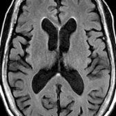 Axial FLAIR MR in a 79-year-old man shows enlargement of ventricles & sulci due to age-related volume loss. Smooth, thin, periventricular hyperintense rim   & subtle hyperintensity in the splenium  of corpus callosum is common & normal.