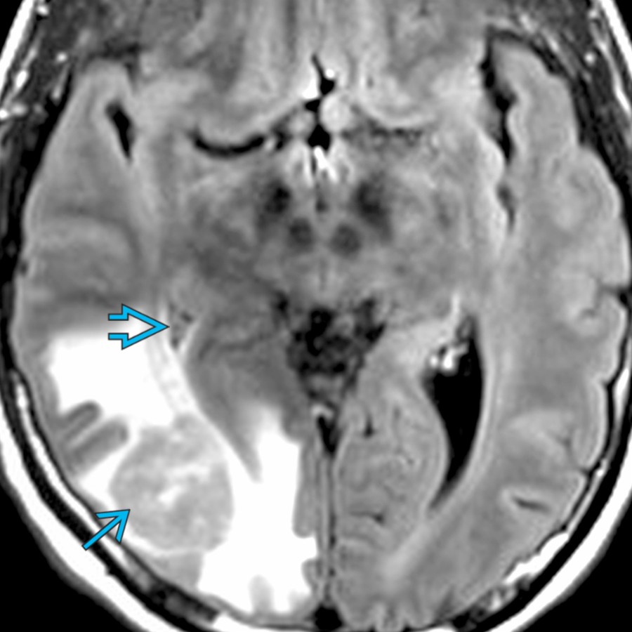 Axial FLAIR MR shows a round mass in the right occipital lobe  (primary CNS lymphoma) that effaces the adjacent right occipital horn and atrium . Extrinsic mass effect is a common cause of ventricular asymmetry and compression.