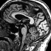 Sagittal T1WI MR (3D MPRAGE) in an 80-year-old woman with PSP shows striking midbrain volume loss, with the penguin or hummingbird sign manifested by a concave upper border of the midbrain . Note extreme thinning of the tectal plate . An incidental subependymoma    was found.