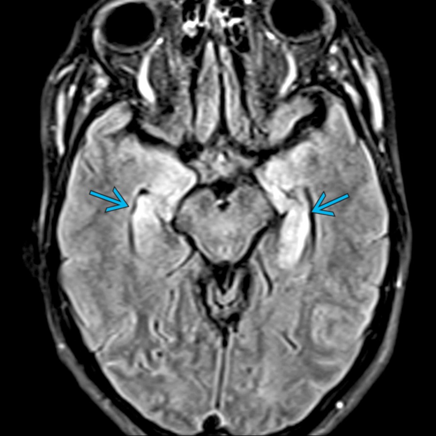 Axial FLAIR MR shows bilateral hyperintensity of the hippocampi and medial temporal lobes . In this patient with a history of lung cancer, this is consistent with autoimmune encephalitis.