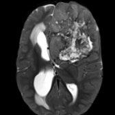 Axial T2 MR shows a large, heterogeneous mass with central necrosis and blood products  causing midline shift  and hydrocephalus .