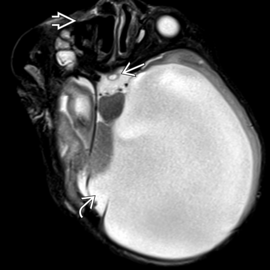 Axial T2 MR shows a persistent infundibular recess . There is additional cleft lip  and hydrocephalus with medial atrial diverticulum .