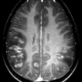 Axial T1 C+ MR in the same patient shows marked, irregular enhancement of nearly all lesions. As ADEM is a monophasic illness, enhancement of the majority of lesions is typical; all lesions have a similar time course. Enhancement of multiple sclerosis (MS) lesions is more variable.