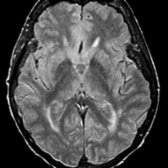Axial PD FSE intermediate MR in a 79-year-old patient without cognitive impairment shows mild periventricular white matter hyperintensities.