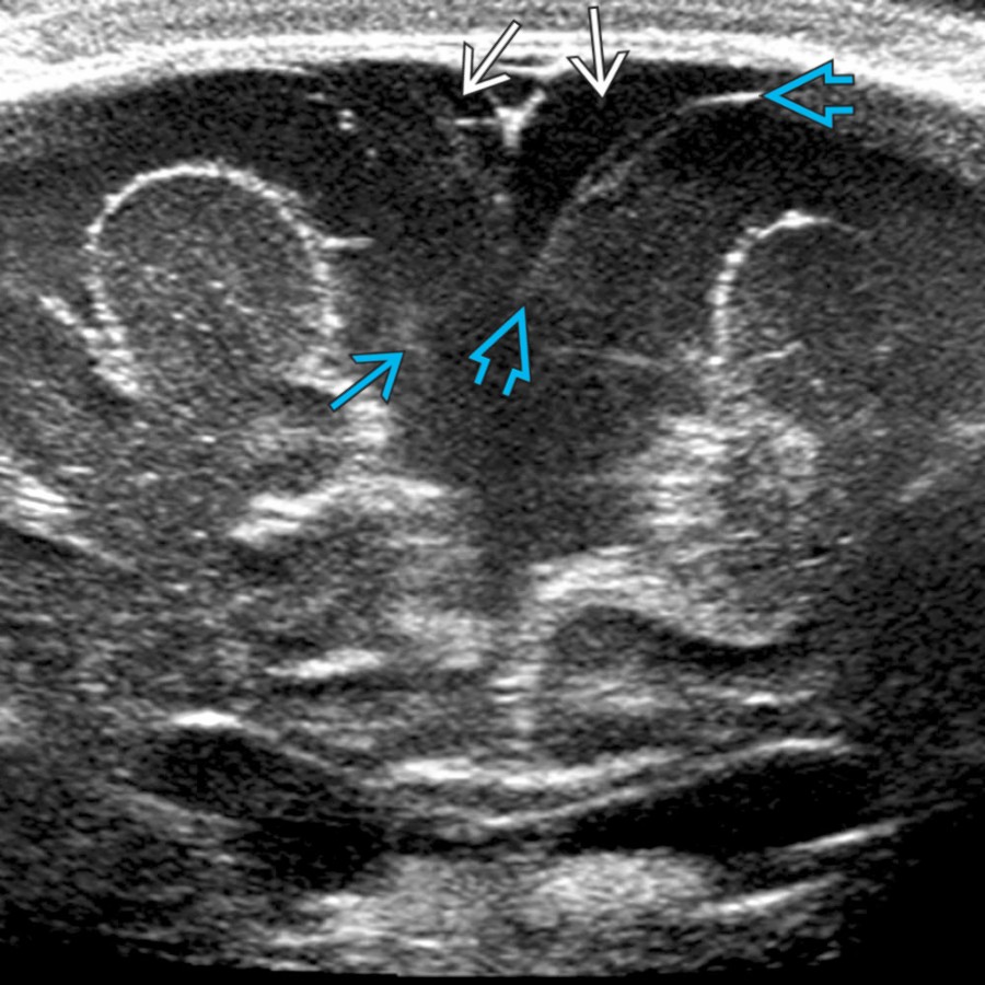 Coronal high-resolution US in a 4-month-old girl with macrocrania shows bilateral enlargement of the SAS . Also present are small, bilateral, subdural collections , which are anechoic compared to the SAS. Note the separation of the arachnoid membrane .