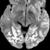 Axial DWI MR of a 61-year-old woman patient with sCJD 'Heidenhain clinical phenotype presenting with visual hallucination and optical distortion is shown. Image demonstrates cortical restricted diffusion in bilateral occipital lobes .
