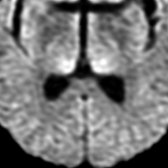 Axial DWI MR in a different patient with vCJD shows diffusion restriction in bilateral posterior aspect of thalami in pulvinar region indicating pulvinar sign  . These signs are more common in vCJD but can occur in sporadic cases.