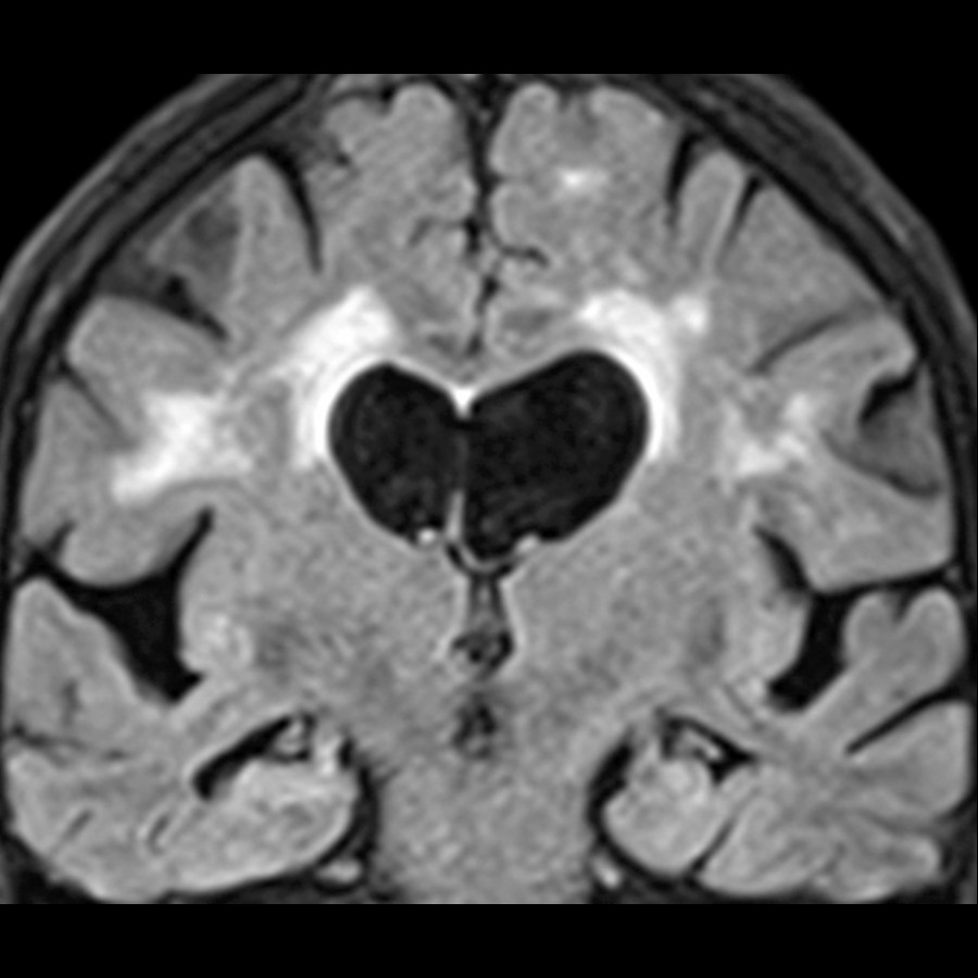 Coronal FLAIR MR of a 72-year-old woman demonstrates FLAIR signal abnormality in the periventricular and subcortical white matter (leukoaraiosis). This finding is consistent with a small vessel ischemic etiology.