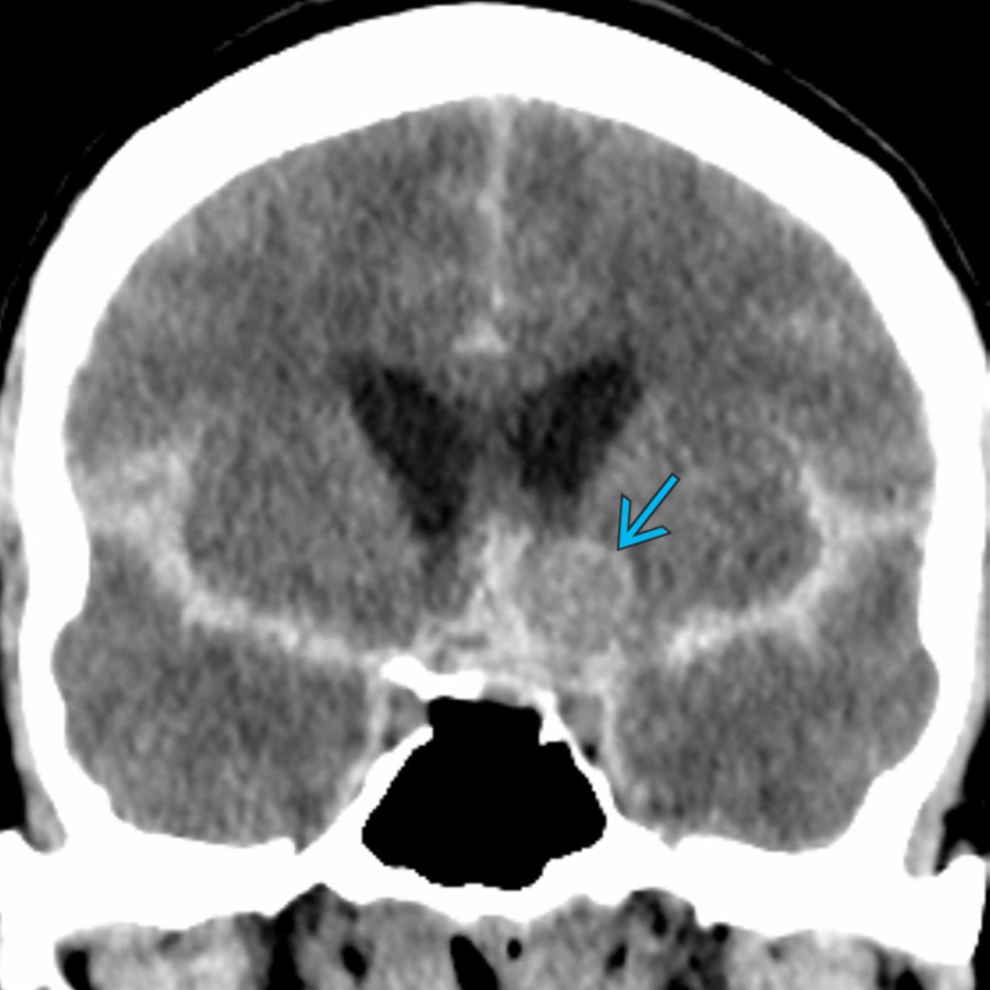 Coronal reformatted NECT in a patient with severe headache shows extensive hyperdense acute SAH in the bilateral MCA cisterns, sylvian fissures, suprasellar cistern, & anterior interhemispheric fissure. Note a slight hyperdense space occupying lesion (SOL) in the left inferior frontal parasagittal region .
