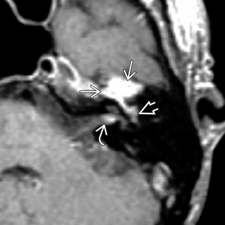 Axial T1 C+ MR in the same patient shows a poorly marginated, avidly enhancing lesion in the geniculate fossa . Note extension along the tympanic segment of CNVII  and into the fundus of the internal auditory canal (IAC) . IAC extension occurred via the labyrinthine segment of CNVII (not shown).
