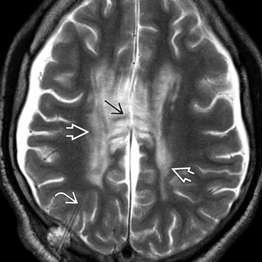 Axial T2WI MR in a patient with corpus callosum impingement syndrome, after shunting for severe IVOH, shows a shunt tube , bilateral subdural fluid collections, and striated hyperintensity in the corpus callosum  with somewhat less striking changes in the periventricular white matter  . (Courtesy S. Candy, MD.)