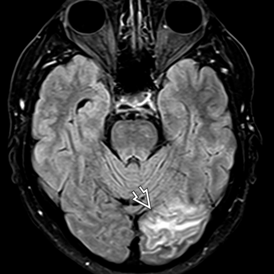 Axial FLAIR MR in a 58-year-old man 1 week after onset of visual changes shows classic imaging of a subacute infarct with hyperintensity in the cortex and subcortical white matter of the occipital lobe  in a PCA distribution.