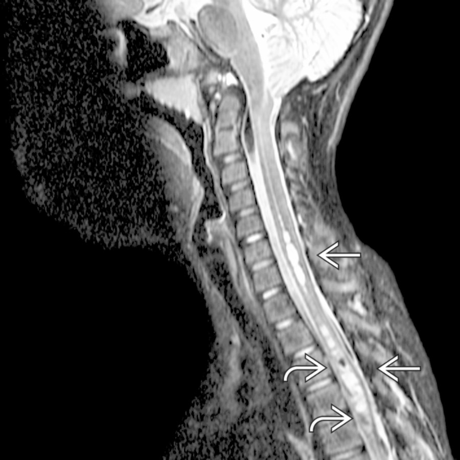 Sagittal T2 MR shows haustrated CSF signal mass  in the central cord in a patient with a Chiari 1 malformation. Hypointense foci  are due to flow artifact.