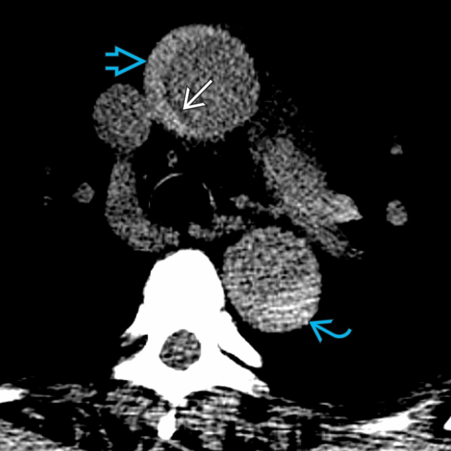 Narrow window settings can improve the visibility of the hyperattenuated, crescent-shaped ascending  and descending  aortic wall. A hypoattenuating, crescent-shaped thickened intima  is also notable due to atherosclerosis.