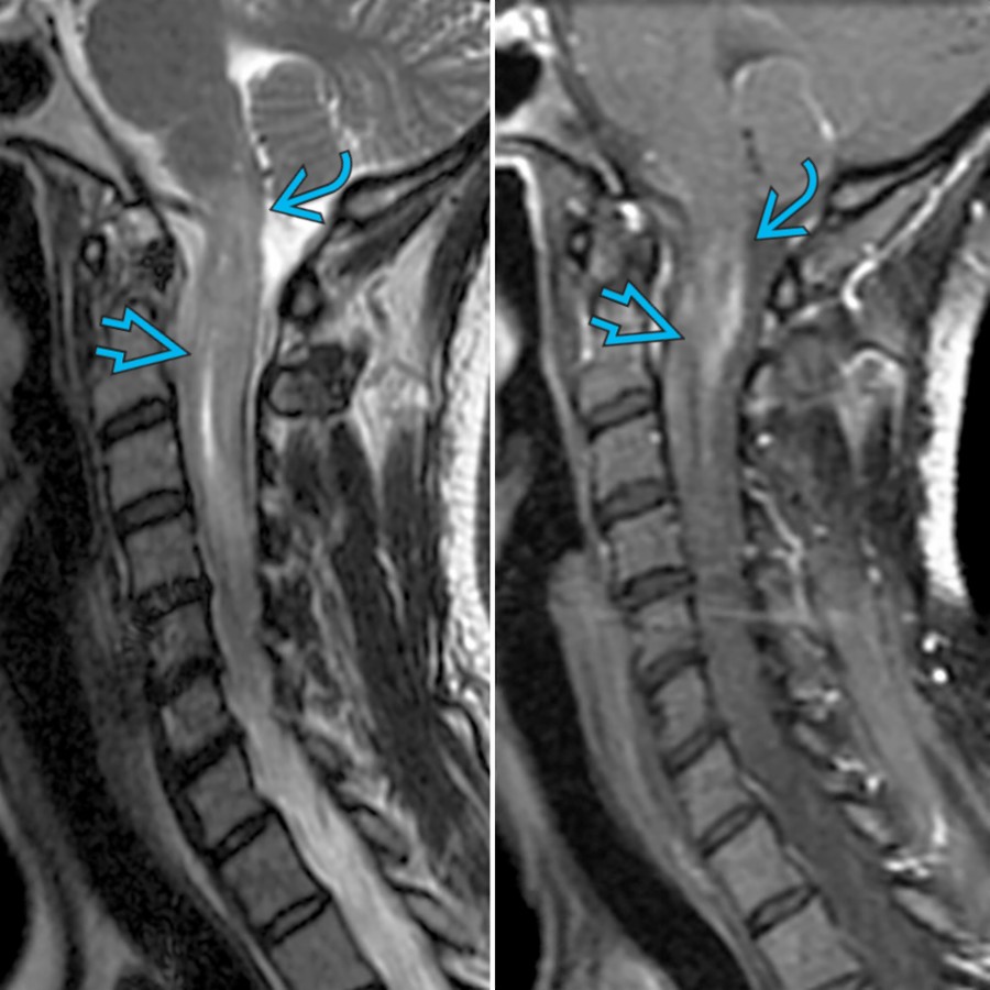 Sagittal T2 MR (right) and T1 C+ MR (left) in a patient with NMOSD presenting with nausea and myelopathy demonstrate patchy enhancing lesion involving the dorsal medulla  (area postrema region) and the upper cervical cord .