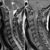 Sagittal T2 MR (right) and T1 C+ MR (left) in a patient with NMOSD presenting with nausea and myelopathy demonstrate patchy enhancing lesion involving the dorsal medulla  (area postrema region) and the upper cervical cord .
