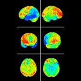 Brain surface map of F-18 FDG PET in a patient with lvPPA demonstrates hypometabolism  throughout the left temporoparietal region. Notice the asymmetry compared to the contralateral temporal lobe .