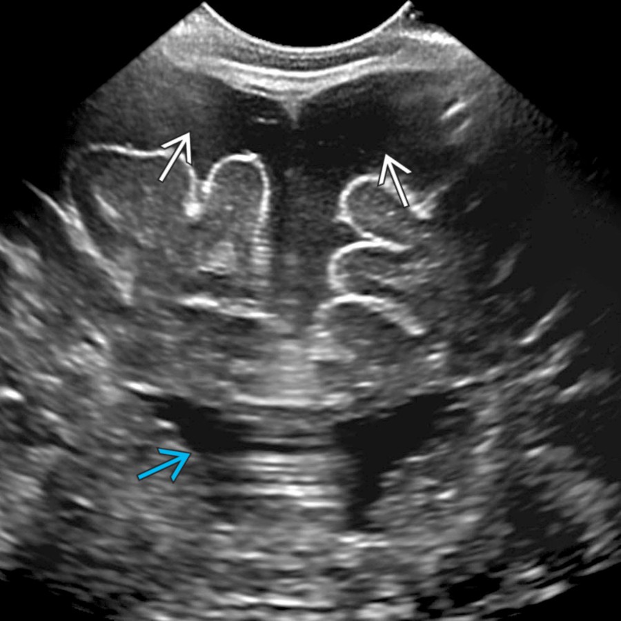 Coronal US in a 7-month-old boy with macrocrania shows enlarged SAS   & normal ventricular  size. Note the normal size of the sulci. This is a typical clinical history & imaging appearance for benign enlargement of the SAS.