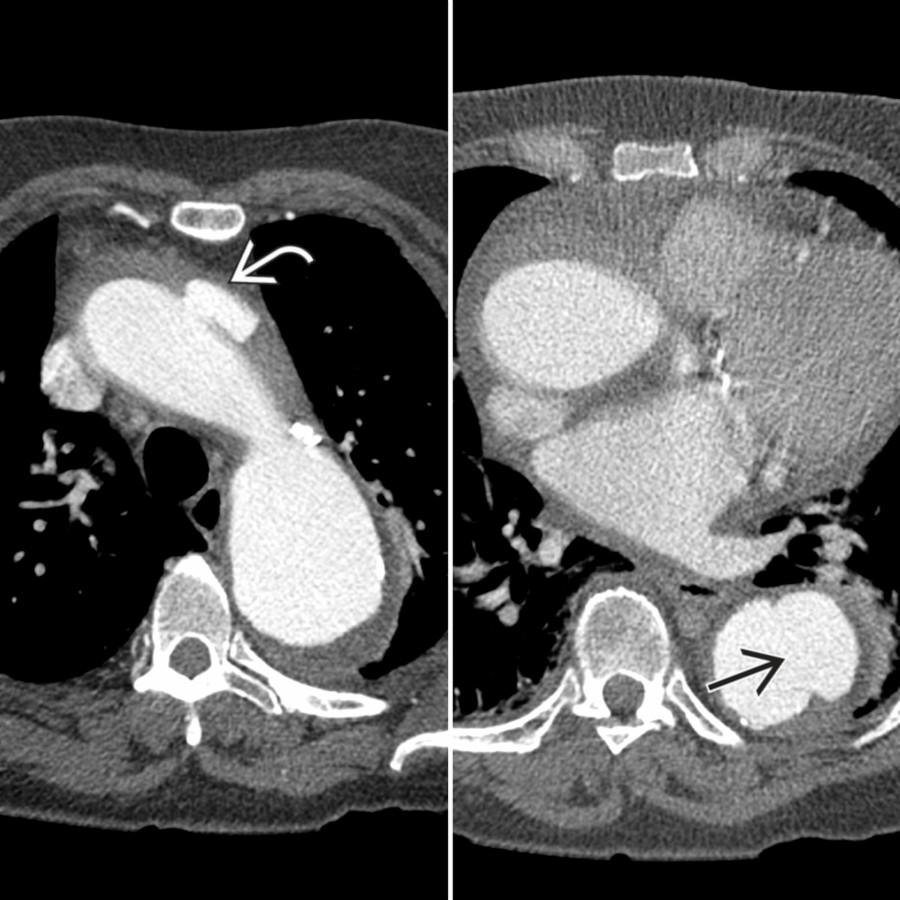 Axial chest CTA in a patient with IMH shows a large penetrating aortic ulcer (PAU)  with a broad neck along the distal thoracic aorta, likely the primary cause of the IMH. Note also an ulcer-like projection (ULP)  along the aortic arch.