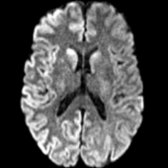 A 53-year-old man with rapidly progressing cognitive decline due to sporadic Creutzfeldt-Jakob disease (sCJD) is shown. Axial DWI MR demonstrates symmetric bilateral basal ganglia (BG) diffusion restriction  and asymmetric cortical restricted diffusion (cortical ribbon sign) in bilateral (right > > left) hemispheres .