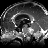 Sagittal T1 C+ MR shows 3 nodular masses in the posterior fossa within the cisterna magna , 4th ventricle , and premedullary cistern .