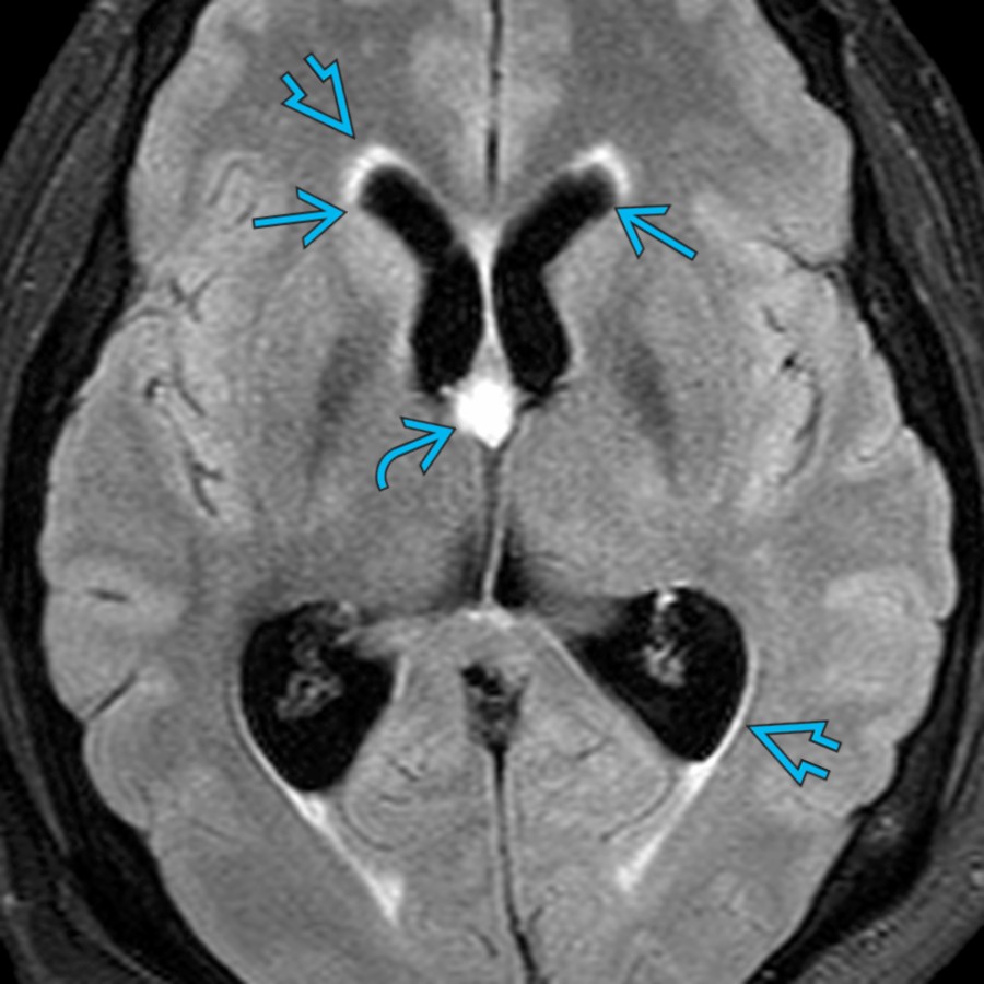 Axial FLAIR MR in a patient with headache and vomiting demonstrates a colloid cyst at the foramen of Monro  causing intraventricular obstructive hydrocephalus (IVOH) with dilatation of both lateral ventricles . Note thin rim of periventricular hyperintensity  due to interstitial edema.