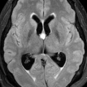 Axial FLAIR MR in a patient with headache and vomiting demonstrates a colloid cyst at the foramen of Monro  causing intraventricular obstructive hydrocephalus (IVOH) with dilatation of both lateral ventricles . Note thin rim of periventricular hyperintensity  due to interstitial edema.