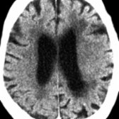 Axial NECT in a patient with multi-infarct dementia and a history of numerous strokes shows diffuse atrophy with multiple old focal cortical infarcts  and confluent periventricular white matter hypodensities , consistent with arteriolosclerosis and lipohyalinosis.