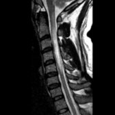 Sagittal T2 DP FSE MR in the same patient shows a long segment of cord enlargement with hyperintensity. Ill-defined enhancement was also present in the cervical cord in this patient with myelopathy and vision loss. Patients with NMO have a worse prognosis with more severe disability than multiple sclerosis, despite lack of brain involvement.
