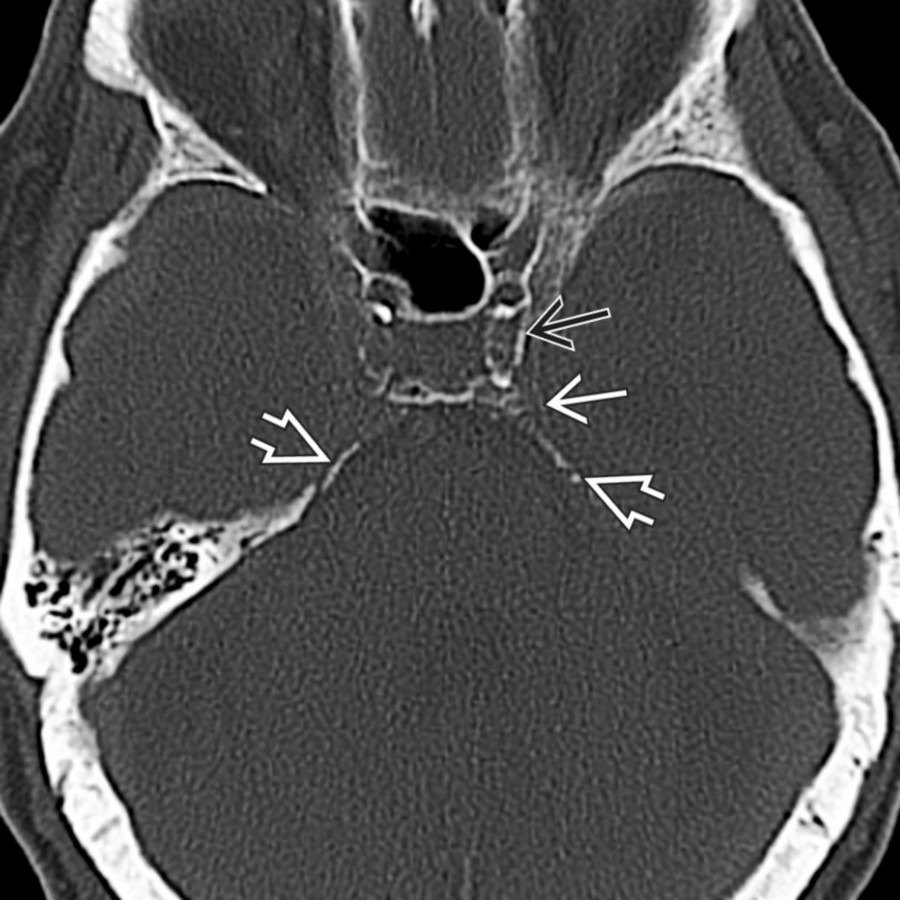 Axial bone CT shows physiologic calcification in both cavernous internal carotid arteries  as well as the dura of the cavernous sinus wall  and both petroclinoid ligaments .