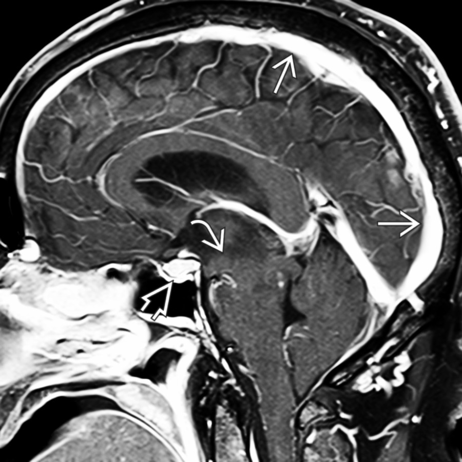 Sagittal T1 C+ FS MR in the same patient shows the severe midbrain slumping   and inferiorly displaced tonsils. In addition, the pituitary gland appears "fat"  and the dural venous sinuses are engorged .