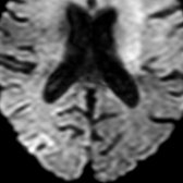 Axial DWI MR in a different patient shows hyperintense signal consistent with restricted diffusion in right posterior temporal lobe and occipital lobe cortex.