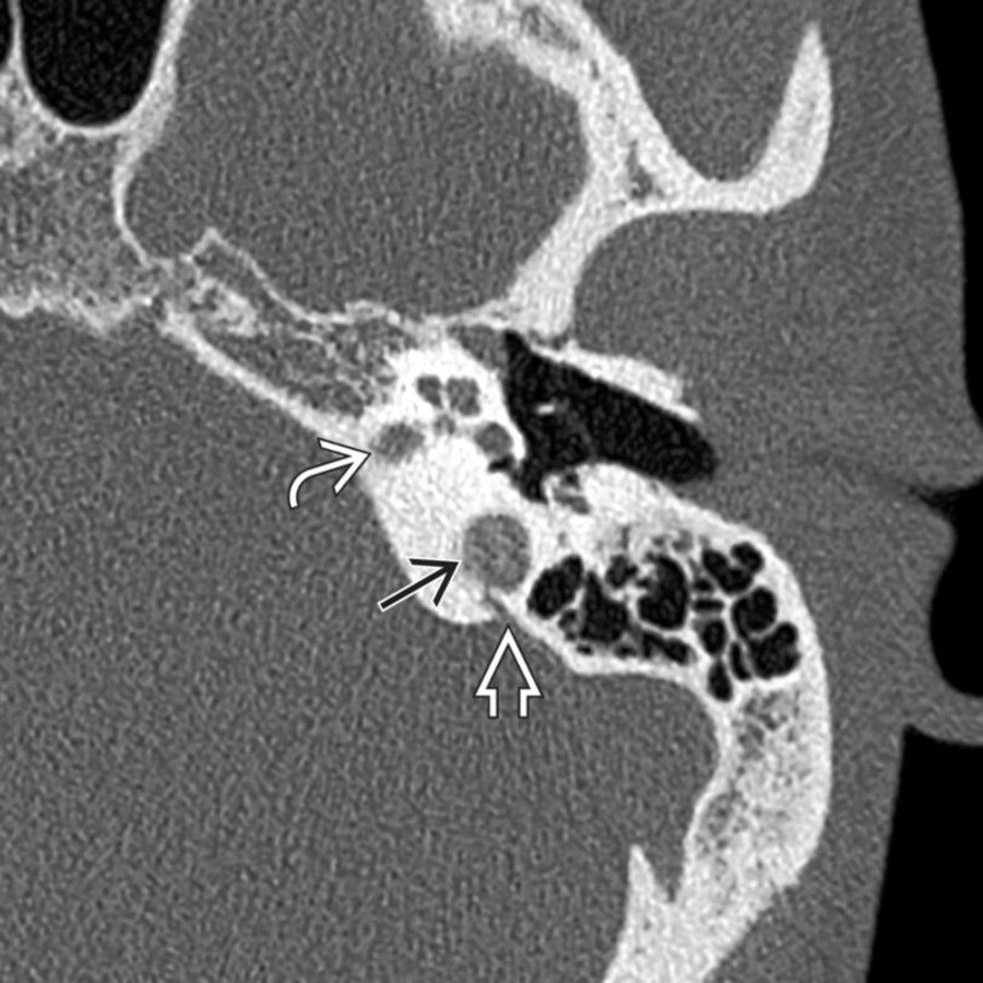 Axial bone CT shows a high jugular bulb  visible at the level of the internal auditory canal . The high jugular bulb abuts the bony vestibular aqueduct . Note that it does not enter the middle ear cavity as a dehiscent jugular bulb might.