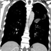 Coronal CECT of a 27-year-old man with bronchial atresia shows a nonenhancing left upper lobe tubular opacity that corresponds to an atretic bronchus impacted with mucus .
