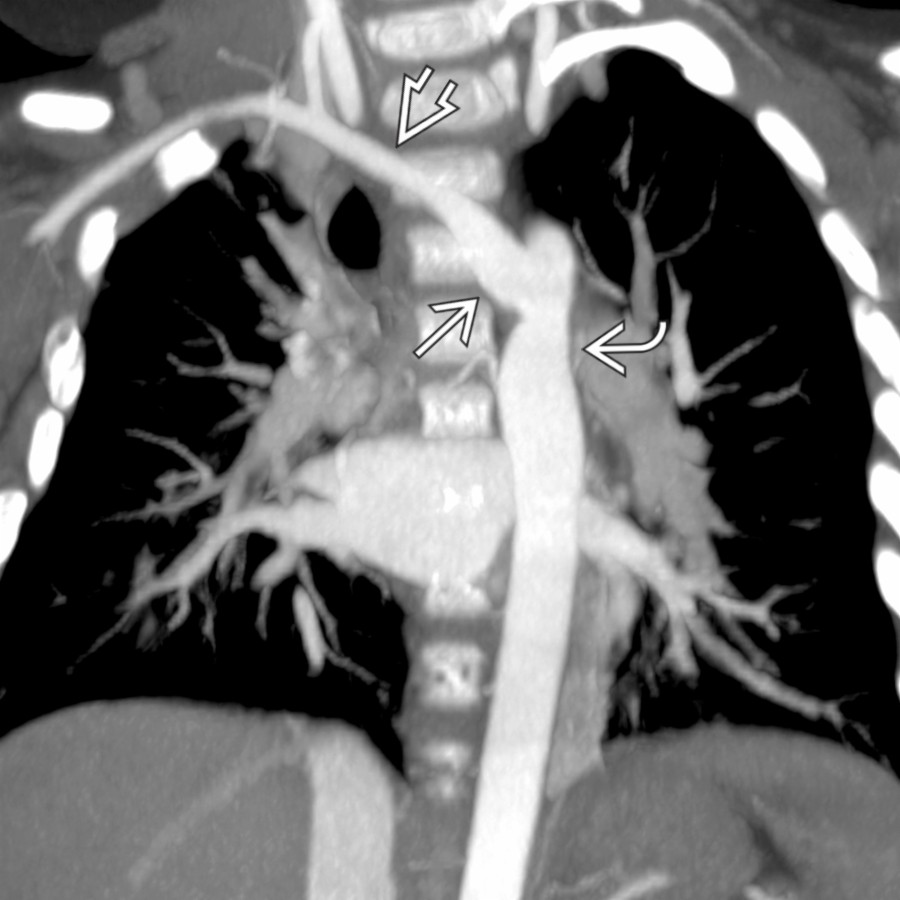 Coronal oblique MIP CTA shows a prominent Kommerell diverticulum , which is a dilatation of a proximal ARSA  that originates in the proximal descending aorta .