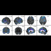 Surface projections show anterior and middle cingulate hypometabolism  with subtle hypometabolism of the precuneus  in this patient with suspected frontotemporal dementia. Note relative sparing of the parietal and posterior temporal lobes. Amyloid CSF confirmed dysexecutive variant AD.