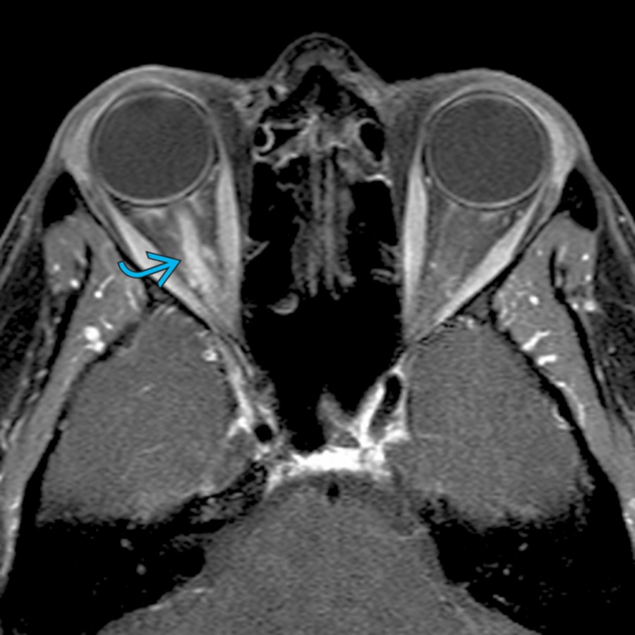 Axial T1 C+ MR in a 22-year-old woman with right vision loss demonstrates swelling with enhancement  of the intraorbital segment of the right optic nerve.